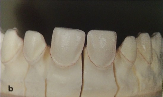 Препаровані зуби вестибулярно